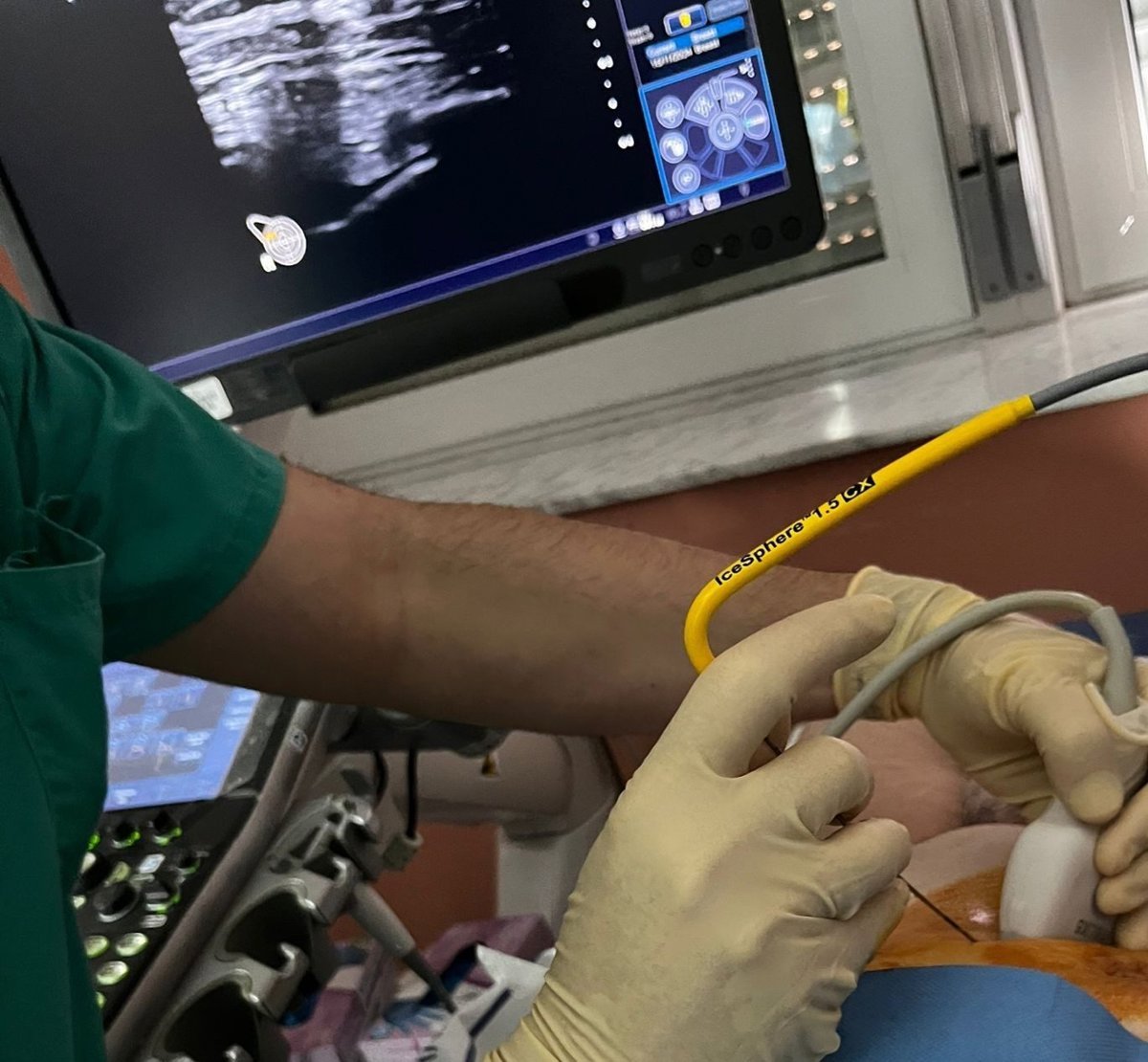 El Hospital La Candelaria aplica crioablación en cáncer de mama